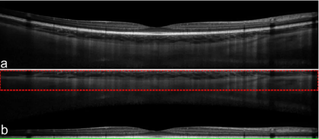 Figure 3. Original B-scan (a) and its equivalent flattened version (b). The red dotted box represents the cropped  region of interest (~565 microns thick), to be used during the OCB segmentation