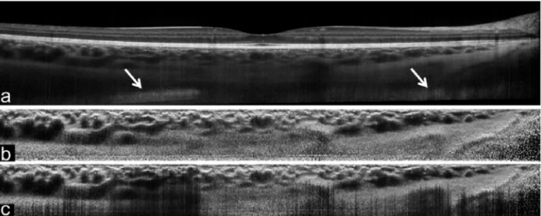 Fig. 4. Example of the image enhancement of a B-scan with artifacts (mirror image artifact marked by arrows)