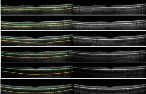 Figure 6. Six B-scans from six different subjects are shown with the derived inner and outer choroidal boundaries  (left), along with the original B-Scan images (right)