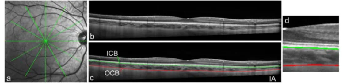 Fig. 1. Example of the retinal fundus en face image showing the scanning protocol (a) and the spectral domain OCT  B-scan captured using the instrument’s high resolution scanning protocol (b)