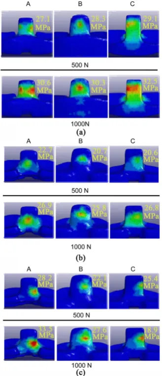 Figure 5. Von Mises-equivalent stress distribution. Top: 500 N. Bottom: 1000 N. (a) −10˚ flexion; (b) 120˚ flexion; (c) 120˚ flexion + 10˚ internal rotation