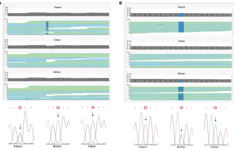 Figure 1 Example of pathogenic mutations identified in the cohort.Notes: (A) Image of the binary alignment map files showing the forward and reverse reads of a segment of the GABBR2 gene; the mutation from C to T in heterozygosity in the proband, not prese