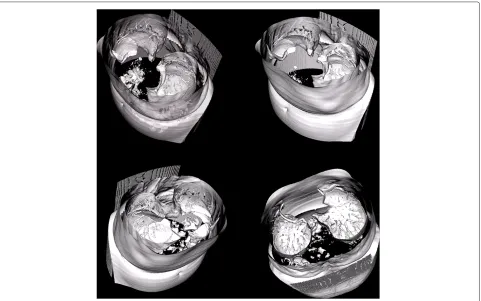 Figure 14 Results of the 380 slice X-Ray scan segmentation–bone structure segmentation.