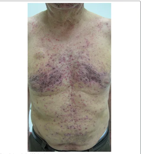 Figure 1 Panitunumab-related follicular rash.