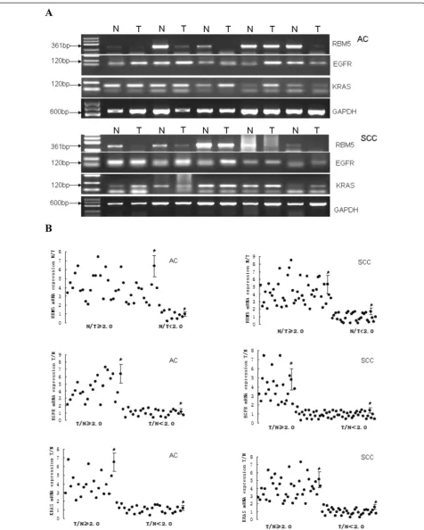 Figure 1 Expression of RBM5, EGFR and KRAS mRNA in NSCLC. A, Agarose gel of semi-quantitative RT-PCR data of RBM5, EGFR, and KRASmRNA expression in representative NSCLC and non-tumor specimens