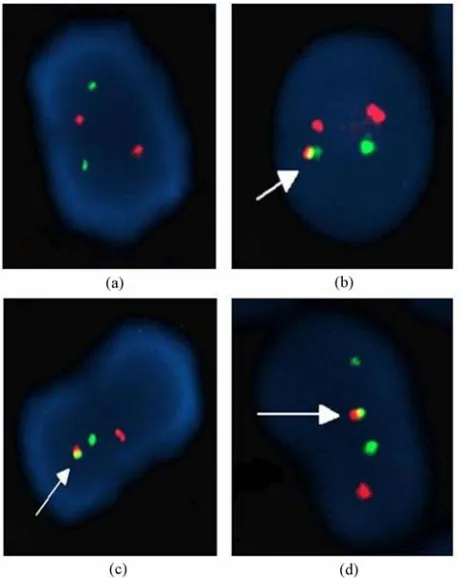 Figure 2. Interphase nuclei showing normal pattern and t(15;17) found with LSI PML/RARA Dual Color Dual Fusion Translocation Probe (a-b), normal pattern and inv(16) found with LSI CBFB Dual Color Break Apart Rearrangement Probe (c-d)