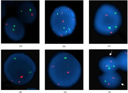 Figure 3. Abnormal FISH patterns (a) monosomy 9 with LSI BCR/ABL ES Dual Color Translocation probe, (b) tetrasomies 8 and 21, (c) trisomy 21, (d) trisomy 8, (e) trisomy 8 and monosomy 21 found with LSI AML1/ETO Dual Color Dual Fusion Translocation Probe, (