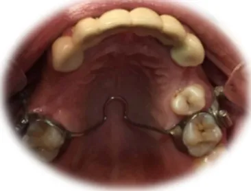 Figure 4. OPG following extraction of heavily destroyed teeth and the placement of Temporary Anchorage Devices and Trans-Palatal Arch in the upper arch