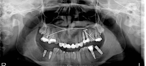 Figure 6. First permanent molar intrusion using mini screws.  