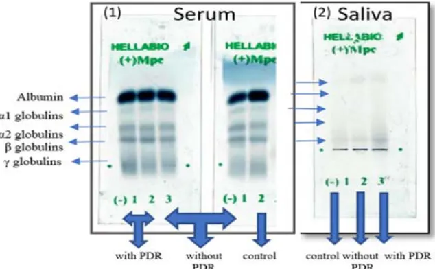 Fig. 1. Electrophoretic profile of pooled crude sera and pooled crude saliva protein of the three studiedgroups on alkaline agarose gel films of Hellabio protein electrophoresis kit