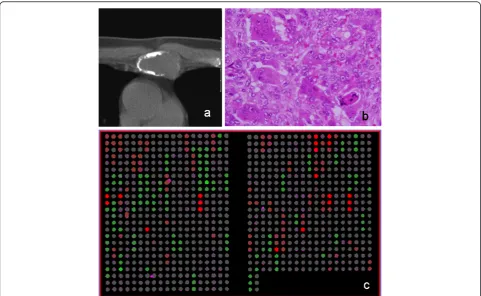 Figure 1 shows a representative case, and a microarrayslide which was hybridized by array CGH technique.DCNAs of primary tumors showed 17.8±12.7% in gains,and 17.3±11.4% in losses of target 287 clones
