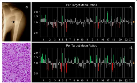 Figure 4 Genetic instability analyzed by array CGH in Case #13. Primary bone tumors showed the genetic instability of 26 DCNAs of 287 clones(c), whereas a metastatic lymph node showed 57 DCNAs in 287 clones (d)