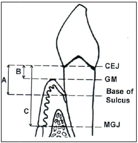 Figure 1. Schematic representation of Conventional Apically Repositioned Flap (CARF) and Modified Apically Schematic representation of Conventional Apically Repositioned Flap (CARF) and Modified Apically Schematic representation of Conventional Apically Re