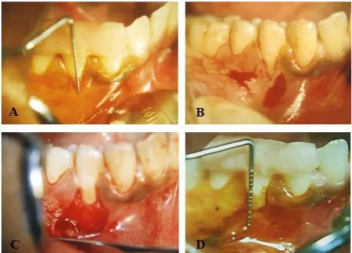 Figure 4. Modified Apically Repositioned Flap. (A) Preoperative clinical measurements with UNC-15 probe with stent in position after stained using iodine, (B) Internal bevel incision in horizontal direction to leave the marginal gingiva intact, (C) Reflect