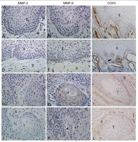 Figure 1 Comparative immunolocalization of MMP-2, MMP-9 (magnification: 400×) and ColIV (magnification: 200×) in normal group,dysplastic oral mucosa group and OTSCC (T and S indicate the tumour and stroma respectively)