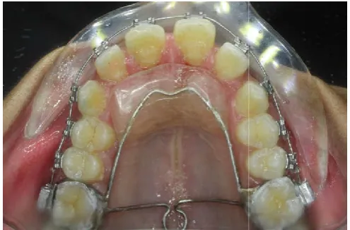 Fig. 2. Bonded acrylic lingual bite planesBonded acrylic lingual bite planes 