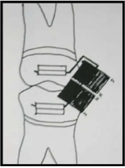 Fig. 12. Attracting magnets for bite opening  