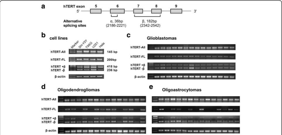 Fig. 1 hTERT alternative splice variant patterns in human gliomas and cell lines.produces a 36-bp in frame deletion; and the a Two main alternative splicing sites: the α splice site in exon 6, which β splice site in exon 7 and exon 8, which results in a 18