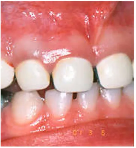 Fig. 4. Cheng crowns  