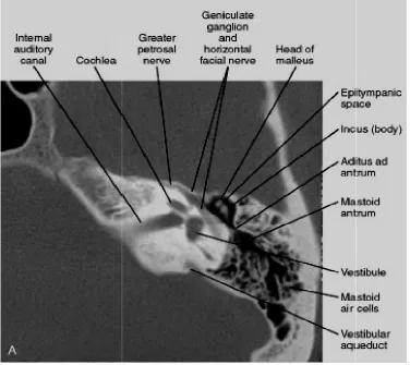 Figure 1. Normal HRCT anatomy of Temporal Bone promontory, basal turn of the cochlea, cochlear duct