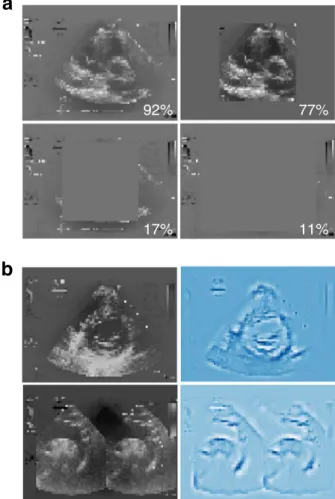 Fig. 6 Visualization of decision-making by neural network. a Occlusion experiments. All test images (a short axis basal sample image is shown here) were modi ﬁed with grey masking of different shapes and sizes as shown, and test accuracy predicted for the 