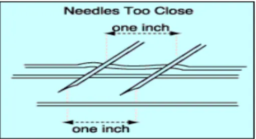 Figure 5. Needle placement if only one  portion of the graft can be used for 