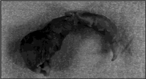 Figure 9. A pseudoaneurysm caused by “one-site-itis,” which can lead to graft failure