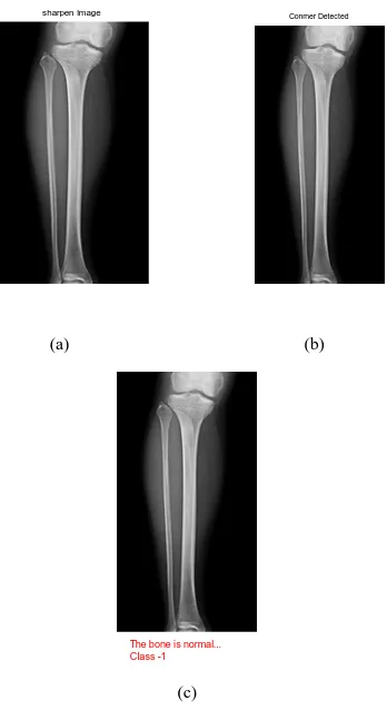 Figure 9. Result of Bone Fracture 