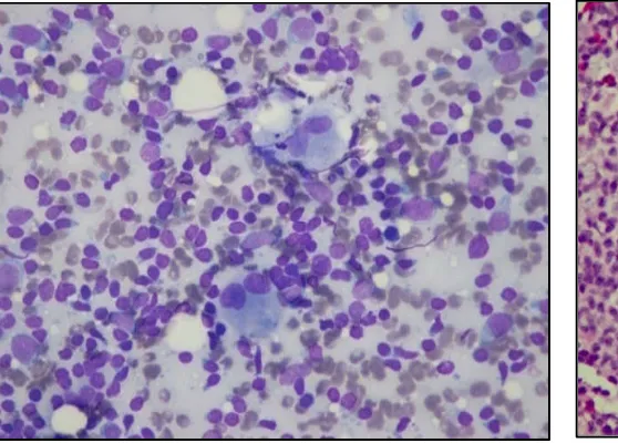 Fig. 6. Microphotograph of a section ofMicrophotograph of a section of Hodgkin's lymphoma 