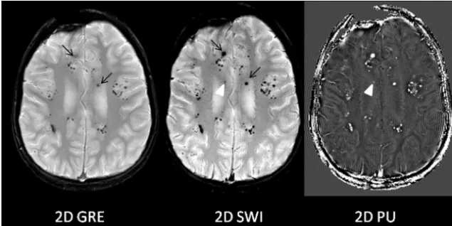 FIG 1. Improved T2* lesion conspicuity on 2D SWI compared with 2D GRE. Multiple T2* lesionsare seen throughout the brain of a 14-year-old boy previously irradiated for medulloblastomaand presumed to have radiation-induced cavernous malformations/telangiect