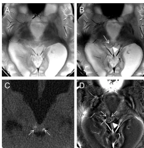 FIG 2. Potential pitfalls of 2D SWI/PU. Focal venous thrombosis (arrowhead2D GRE and 2D SWI ((black arrow) and an adjacent area suspicious for focal venous ischemia (black) on DWI are identiﬁed in a 5-month-old boy with seizures