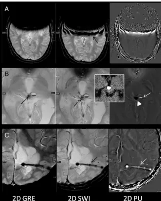 FIG 4. Other comparison features of 2D GRE and 2D SWI/PU.Note increased artifacts on 2D SWI ( A, Dental braces artifacts.arrow) and 2D PU images resulting from dental braces