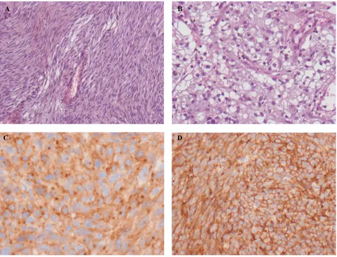 Figure 1 Histologic features of gastrointestinal stromal tumors (GiSTs). A) Spindle cell type