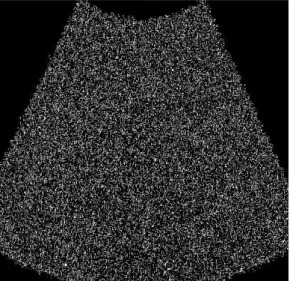 Figure 6.3 : The results of the watershed algorithm without preprocessing  methods (left) the cyst and (right) the liver images
