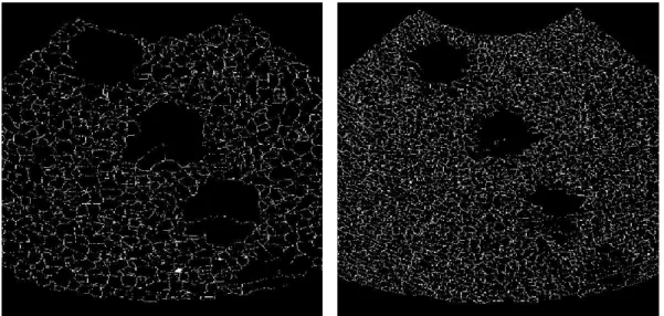 Figure 6.4 : The results of the watershed algorithm on the preprocessed cyst image   using different filtering methods with different window sizes