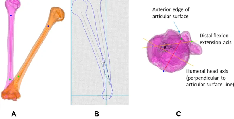 Figure 1 Using customized software (Mimics 14.01 software, Materialise, Leuven, Belgium), 3-D models of the affected and contralateral normal humeri were constructedA)