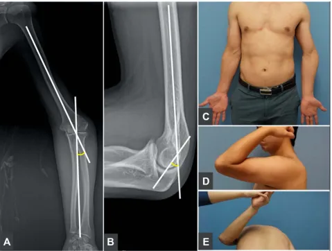 Figure 3 In radiographic measurements, the humerus-elbow-wrist angle (A) comprised the angle between the humeral axis and a line passing through the proximal anddistal midpoints of the radius and ulna