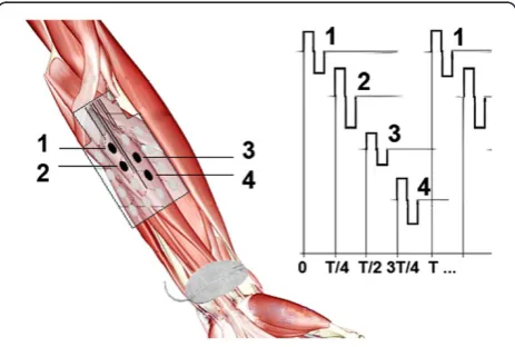 Figure 1 Asynchronous stimulation of motoneurons with themulti-pad electrode. Stimulation pulses (right panel) are timeshifted and delivered to different tissues to activate portions of asingle muscle or multiple muscles