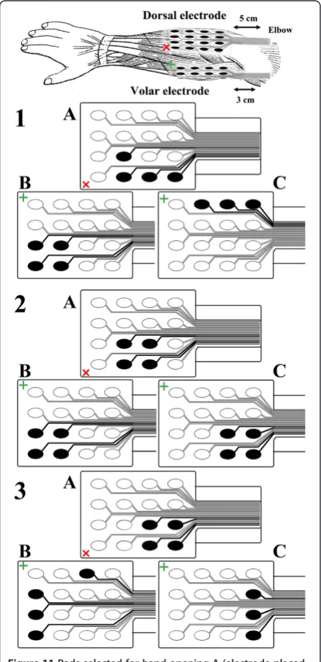 Figure 11 Pads selected for hand opening A (electrode placedon dorsal aspect), grasping B and wrist stabilization C(electrode placed on volar aspect) for 3 patients.