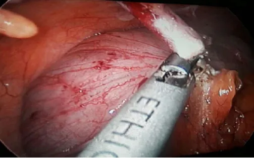 Table 9. Commencement of oral feeding in patients post operatively in two groups  