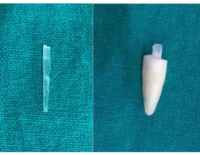 Fig. 1. Cementation of fibre post 