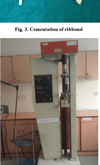 Fig. 3. Cementation of ribbond  