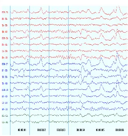 Fig 1.1 (Represents the brain signals measured using an EEG system over 32 regions using the Neuromax Software) 