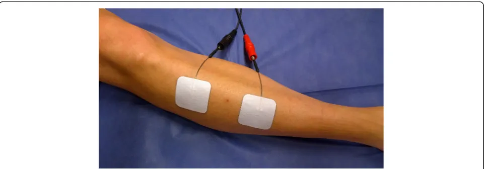 Fig. 2 Stimulation of the extensor digitorum communis muscle (EDC). Positioning of electrodes in bipolar arrangement with two 30 mmdiameter adhesive electrodes were used for the stimulation of the EDC