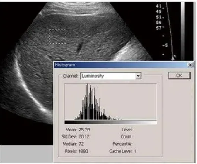 Figure 1. Transaxial scan. A: Transaxial epigastric scan shows the left lobe of the liver with surface irregularity (arrows), and coarse parenchyma echotexture; B: Subcostal transaxial scan shows the inferior margin of right hepatic lobe with irregular surface (arrows)  