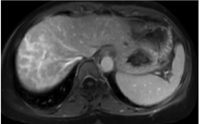 Figure 3. Image of liver cirrhosis caused by chronic hepatitis B. Contrast enhanced computed tomography portal phase image shows the liver  decreased diameter of portal vein (arrow) due to large collateral vessels (arrow head) and also shows large amount o