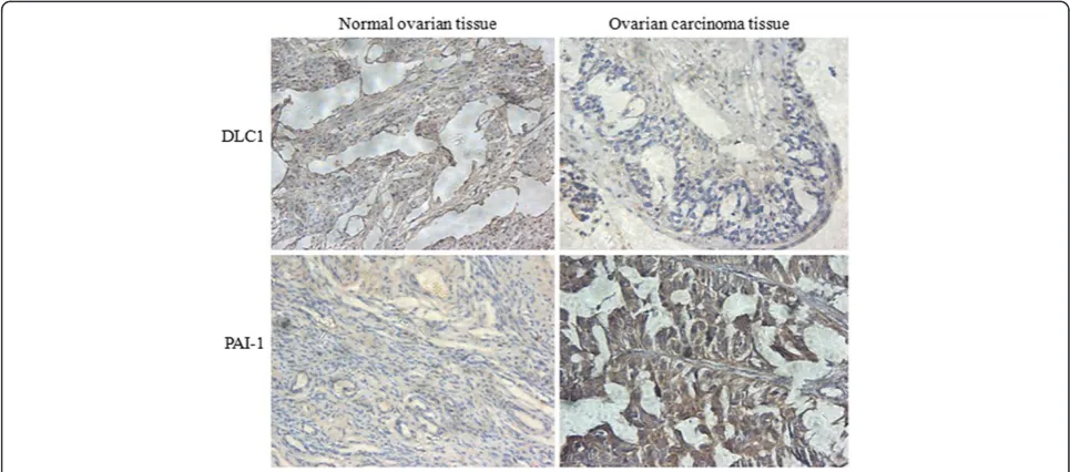 Figure 1 Positive expression of DLC1 and PAI-1 in different ovarian tissues detected by immunohistochemistry staining