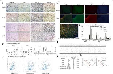 Fig. 1 TGF-tients.β2 and LC3B are highly expressed in glioma and co-localized with each other indicating poor prognosis in glioma patients