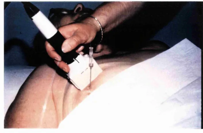 Figure 6.5: ILP in process using ultrasound to monitor hyperthermic changes.