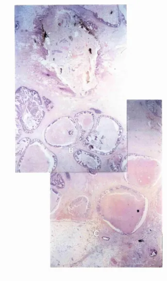 Figure 7.1: The cavity(A) with evidence of charring lining the cavity(arrowed), the area 